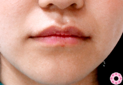 年代：10代 施術名：唇を厚く（ヒアルロン酸） 施術後｜東京形成美容外科