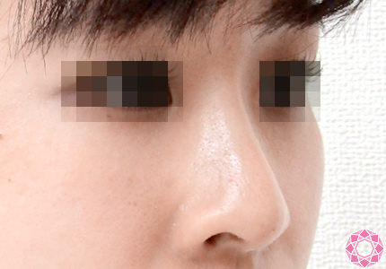 年代：20代 施術名：プチ隆鼻術（ヒアルロン酸） 施術後｜東京形成美容外科