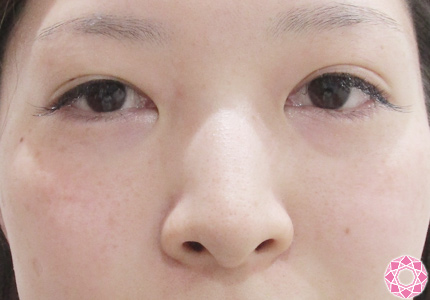年代：20代 施術名：レーザートーニング 施術後｜東京形成美容外科