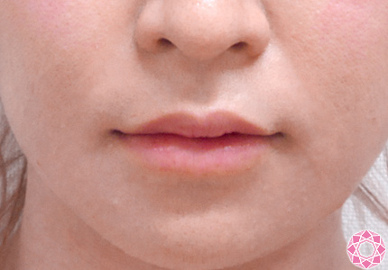 年代：20代 施術名：唇を厚く（ヒアルロン酸） 施術後｜東京形成美容外科