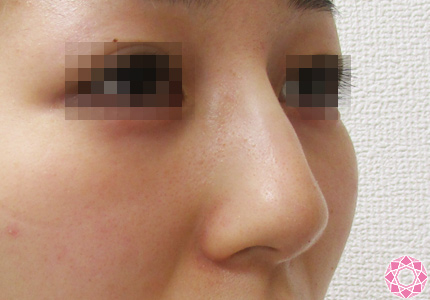 年代：10代 施術名：プチ隆鼻術（ヒアルロン酸） 施術後｜東京形成美容外科