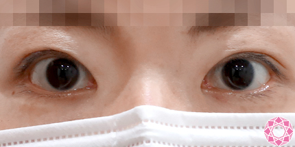 年代：30代 施術名：眼瞼下垂 施術後｜東京形成美容外科