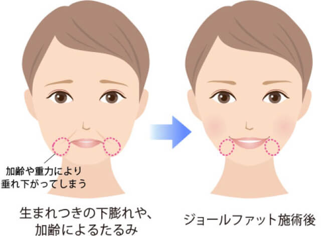 加齢や重力により 垂れ下がってしまう 生まれつきの下膨れや、 加齢によるたるみ ジョールファット施術後は口角まわりがスッキリとする