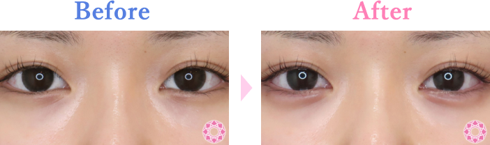 涙袋形成の症例写真 施術前後