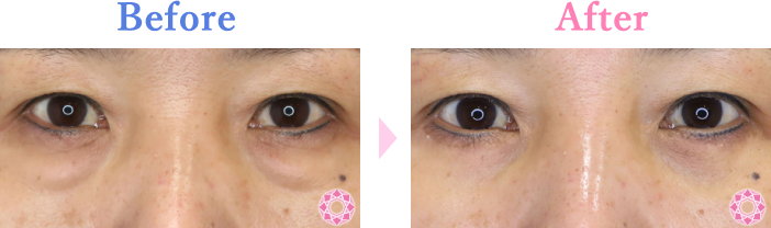 目の下のたるみ取りの症例写真 施術前後