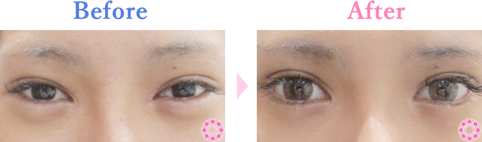 たれ目形成（グラマラスライン）の症例写真 施術前後