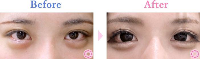 たれ目形成（グラマラスライン）の症例写真 施術前後