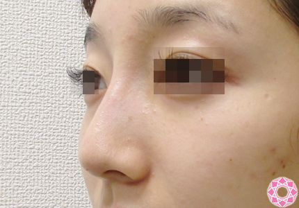 年代：10代 施術名：プチ隆鼻術（ヒアルロン酸） 施術後 拡大画像｜東京形成美容外科