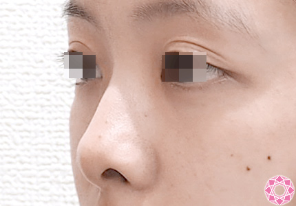 年代：10代 施術名：プチ隆鼻術（ヒアルロン酸） 施術前｜東京形成美容外科
