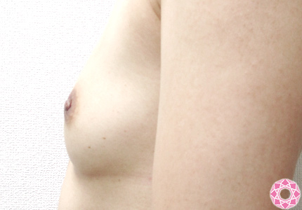 年代：40代 施術名：乳頭縮小・乳頭縮小（乳管温存法） 施術後｜東京形成美容外科