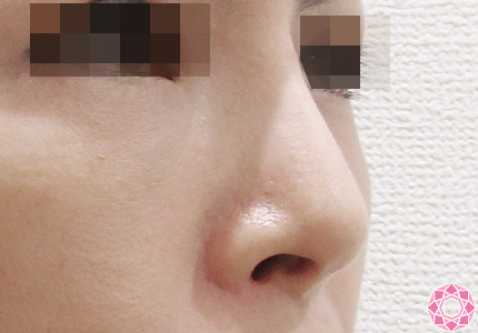 年代：40代 施術名：隆鼻術（シリコンプロテーゼ） 施術後 拡大画像｜東京形成美容外科