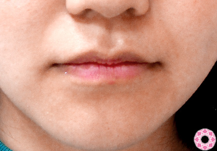年代：10代 施術名：唇を厚く（ヒアルロン酸） 施術前 拡大画像｜東京形成美容外科