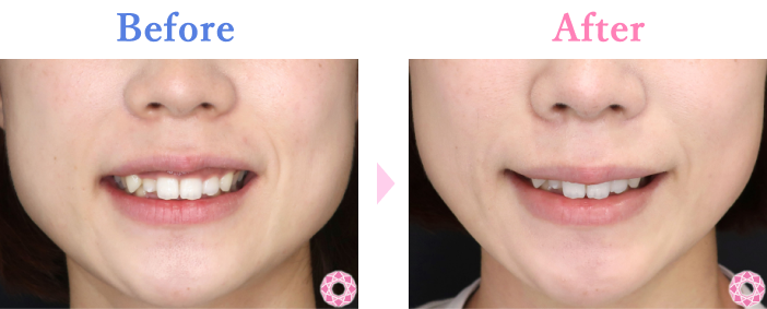 ガミースマイル（切開）の症例写真 施術前後