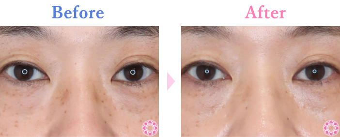 レーザートーニング（そばかす）の症例写真 施術前後