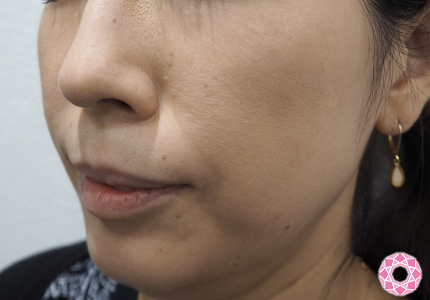 シワ取り ヒアルロン酸 ほうれい線 ゴルゴライン 公式 東京形成美容外科 美容外科 美容皮膚科 船橋駅から徒歩3分