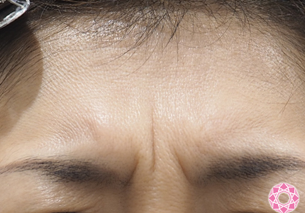眉間のシワへのボトックス注射 公式 東京形成美容外科 美容外科 美容皮膚科 船橋駅から徒歩3分