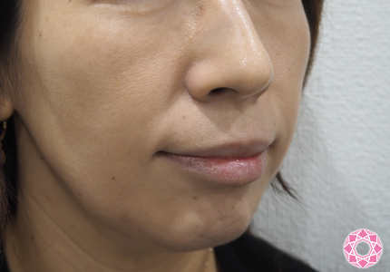シワ取り ヒアルロン酸 ほうれい線 ゴルゴライン 公式 東京形成美容外科 美容外科 美容皮膚科 船橋駅から徒歩3分