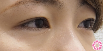 痛くない目のクマ治療 簡単クマケア 症例写真 画像 公式 東京形成美容外科 美容外科 美容皮膚科 船橋駅から徒歩3分