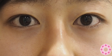 年代：20代 施術名：眼瞼下垂 施術後｜東京形成美容外科