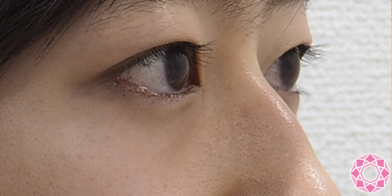 年代：20代 施術名：眼瞼下垂 施術前｜東京形成美容外科