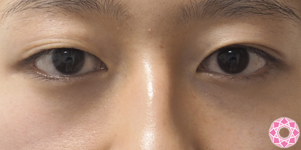 年代：20代 施術名：眼瞼下垂 施術前 拡大画像｜東京形成美容外科