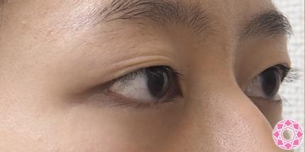 年代：20代 施術名：眼瞼下垂 施術前｜東京形成美容外科