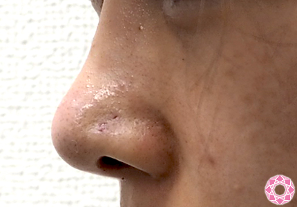 年代：10代 施術名：鼻先（ダンゴ鼻）修正 施術前｜東京形成美容外科