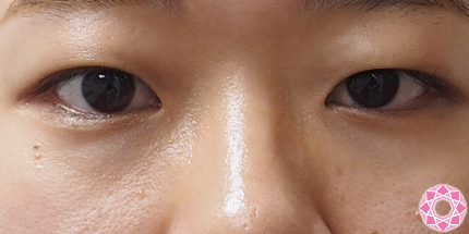 二重埋没法１dayプリンセスクイック法 脂肪とり 症例写真 画像 公式 東京形成美容外科 美容外科 美容皮膚科 船橋駅から徒歩3分