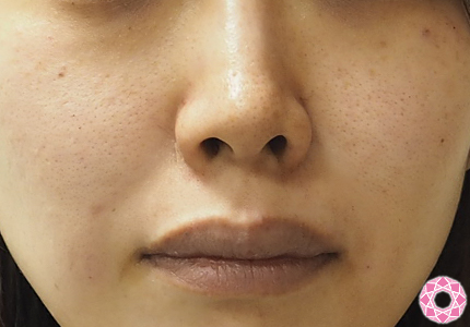 リスクも少ない ほうれい線取りヒアルロン酸注射 公式 東京形成美容外科 美容外科 美容皮膚科 船橋駅から徒歩3分