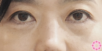 年代：40代 施術名：目の下のふくらみ取り 施術後｜東京形成美容外科