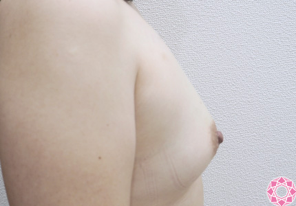 年代：40代 施術名：乳頭縮小・乳頭縮小（乳管温存法） 施術前｜東京形成美容外科