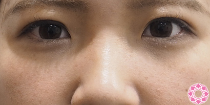 上まぶたのしわ たるみが改善して見える二重埋没法 公式 東京形成美容外科 美容外科 美容皮膚科 船橋駅から徒歩3分