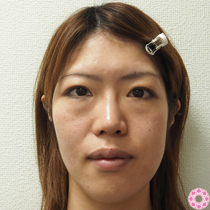 年代：30代 施術名：目の下のふくらみ取り 施術前｜東京形成美容外科