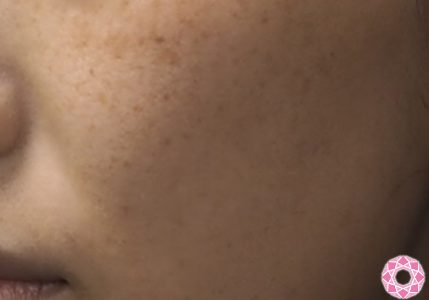 シミ取りレーザー ｑスイッチ 症例写真 美容整形のことなら千葉県船橋市の東京形成美容外科 美容皮膚科 船橋駅から徒歩3分