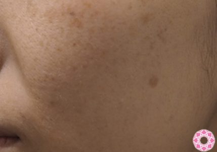 左ほほにスポット シミ取り 公式 東京形成美容外科 美容外科 美容皮膚科 船橋駅から徒歩3分