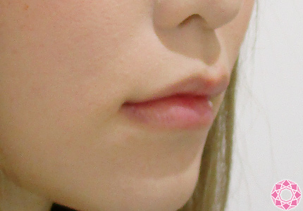 唇を厚く ヒアルロン酸 症例写真 美容整形のことなら千葉県船橋市の東京形成美容外科 美容皮膚科 船橋駅から徒歩3分