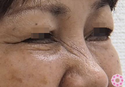 鼻根部のシワを改善したいシワ取りボトックス 公式 東京形成美容外科 美容外科 美容皮膚科 船橋駅から徒歩3分