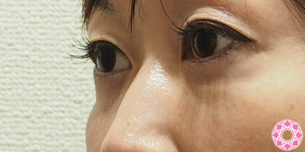 年代：40代 施術名：目の下のふくらみ取り 施術前｜東京形成美容外科