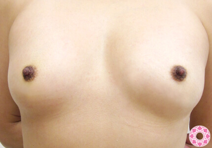 年代：30代 施術名：乳頭縮小・乳頭縮小（乳管温存法） 施術前｜東京形成美容外科