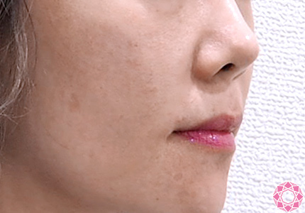 赤ニキビやニキビ跡の凸凹を解消して美しい肌に 公式 東京形成美容外科 美容外科 美容皮膚科 船橋駅から徒歩3分