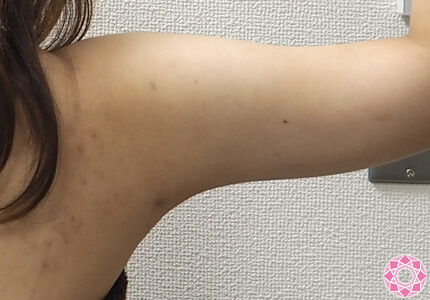 年代：20代 施術名：脂肪吸引 施術後｜東京形成美容外科