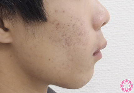 年代：10代 施術名：レーザートーニング（ニキビ） 施術前｜東京形成美容外科