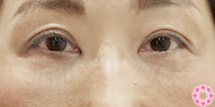 年代：50代 施術名：目の下のふくらみ取り 施術後｜東京形成美容外科