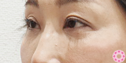 年代：50代 施術名：目の下のふくらみ取り 施術前｜東京形成美容外科