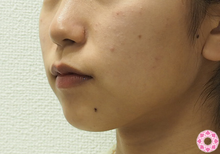 年代：10代 施術名：美肌スレッド 施術前｜東京形成美容外科