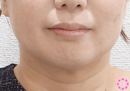 年代：30代 施術名：小顔脂肪吸引 施術前｜東京形成美容外科