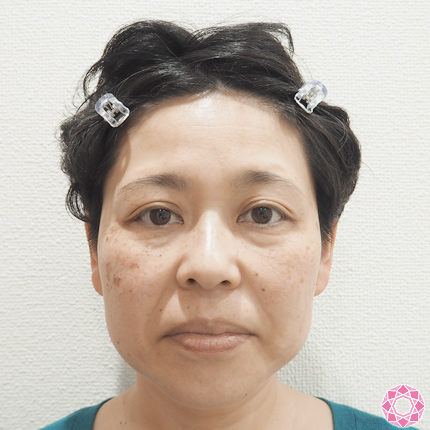 年代：40代 施術名：レーザートーニング 施術前｜東京形成美容外科