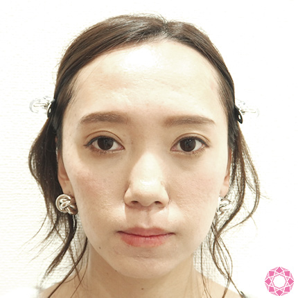 年代：20代 施術名：目の下のふくらみ取り 施術前｜東京形成美容外科
