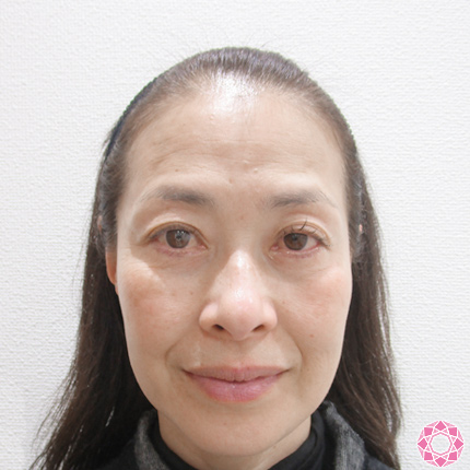 年代：50代 施術名：レーザートーニング 施術前｜東京形成美容外科