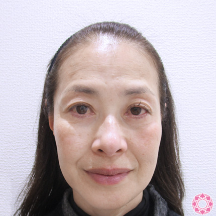 年代：50代 施術名：レーザートーニング 施術前｜東京形成美容外科